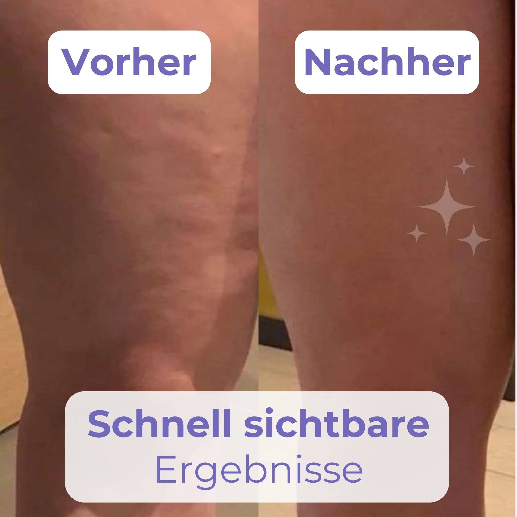 Cellu Patches | Verstecke Cellulite in Sekunden